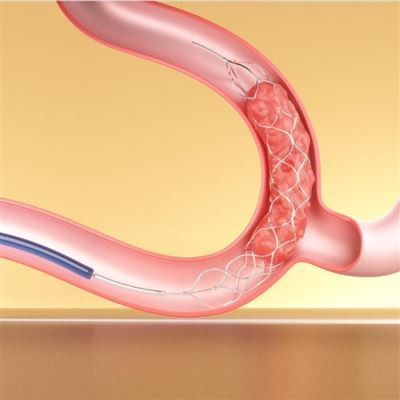 Recuperador de stent combinado con catéter de aspiración